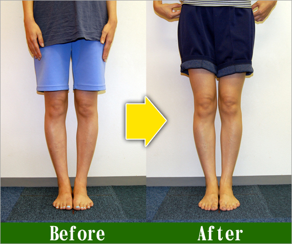 O脚矯正改善写真11