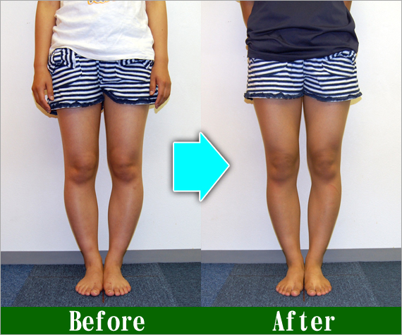 O脚矯正改善写真9